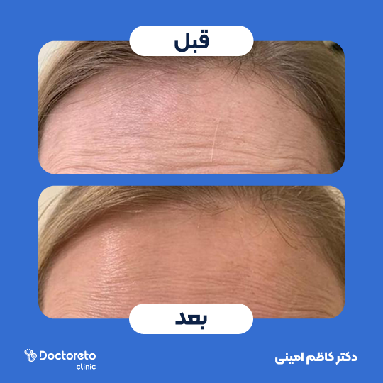 تزریق بوتاکس صورت (پیشانی) با برند مصپورت