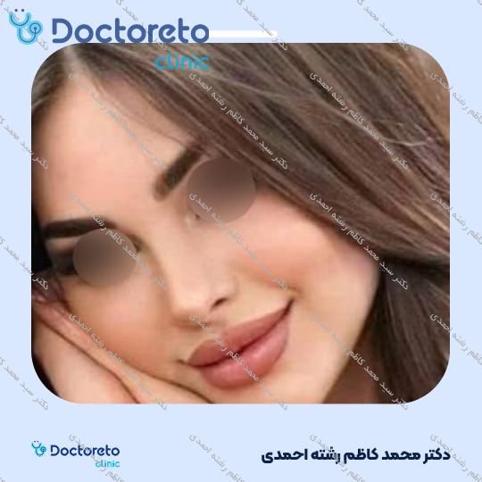 عمل زیبایی بینی (رینوپلاستی)