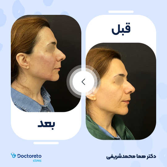 تزریق ژل چانه با برند اینووسنس (1cc) دکتر هما محمدشریفی در اصفهان 9