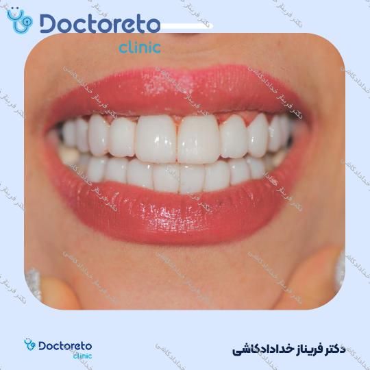 لمینت سرامیکی ایمکس vip (هر واحد)
