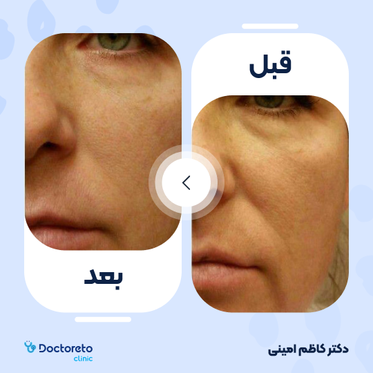 جوانسازی صورت با اگزوزوم تراپی و پلاسماتراپی (هر جلسه)