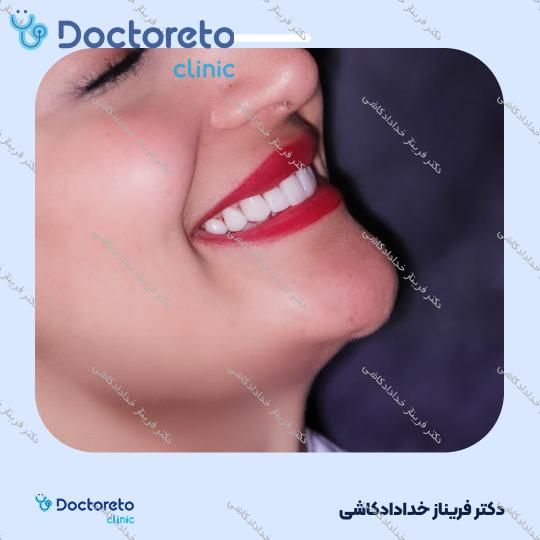 لمینت سرامیکی ایمکس vip (هر واحد)