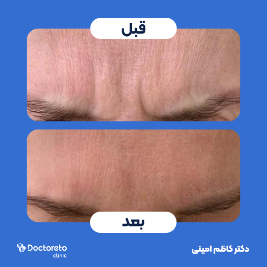 تزریق بوتاکس صورت (خط اخم) با برند مصپورت