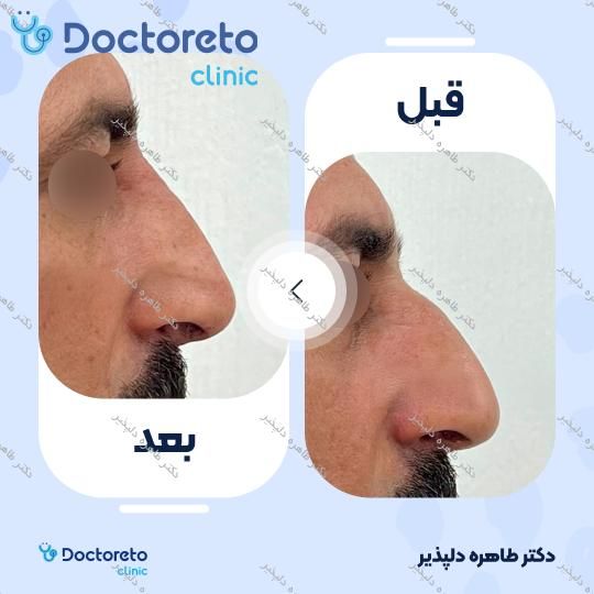 تزریق ژل بینی با برند نورامیس (1cc)