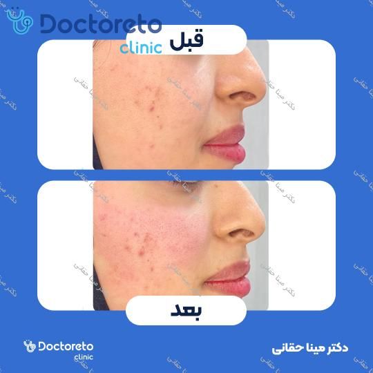 تزریق ژل گونه با برند بلوترو (1CC)