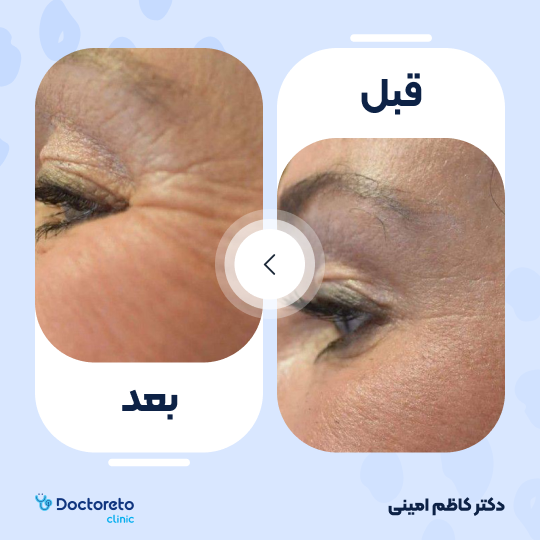 تزریق بوتاکس صورت ( خطوط پنجه کلاغی) با برند مصپورت
