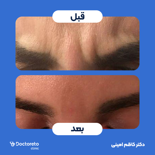 تزریق بوتاکس صورت (خط اخم) با برند مصپورت