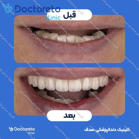 ایمپلنت core1 کره ای با روکش (هر واحد)