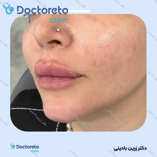 تزریق ژل لب با برند فیوریج (1cc)
