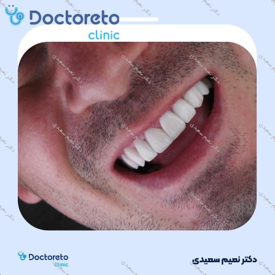 لمینت آی پی اس ایمکس (هر واحد)
