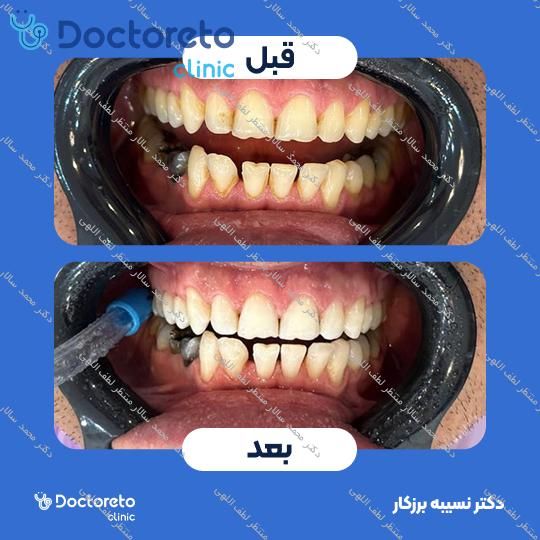 آفیس بلیچینگ (سفید کردن دندان) دو فک با مواد آمریکایی