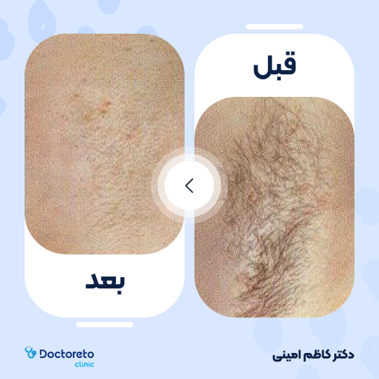 لیزر موهای زائد آقایان (زیر بغل) با دستگاه جونولوکس کره ای