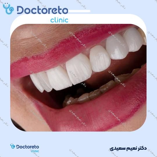 لمینت آی پی اس ایمکس (هر واحد)