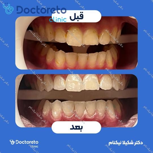 آفیس بلیچینگ هر فک با ماده آمریکایی