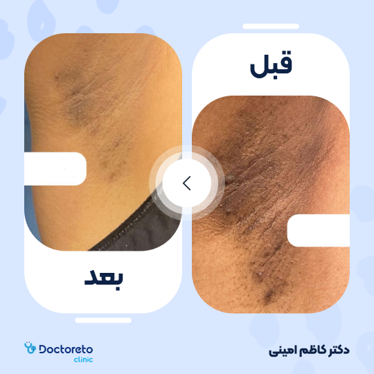 جوانسازی و رفع تیرگی پوست با کربوکسی تراپی (هر جلسه)