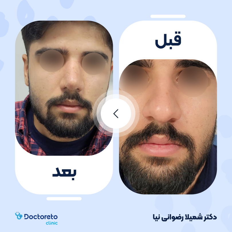 جراحی انحراف بینی (سپتوپلاستی)