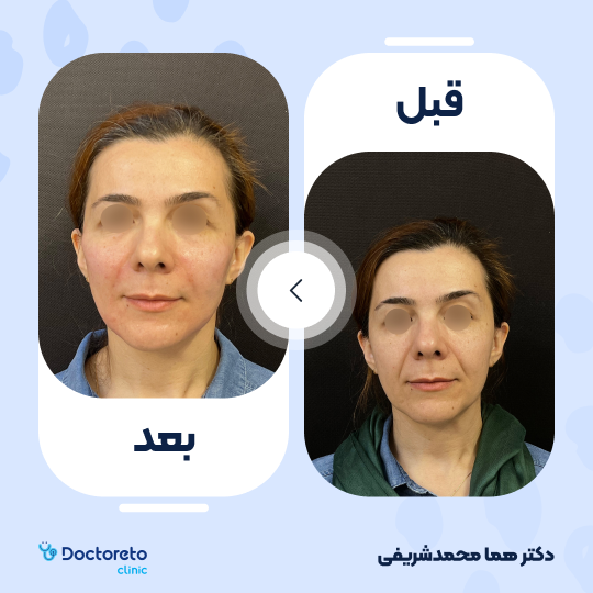 تزریق ژل چانه با برند اینووسنس (1cc) دکتر هما محمدشریفی در اصفهان 8