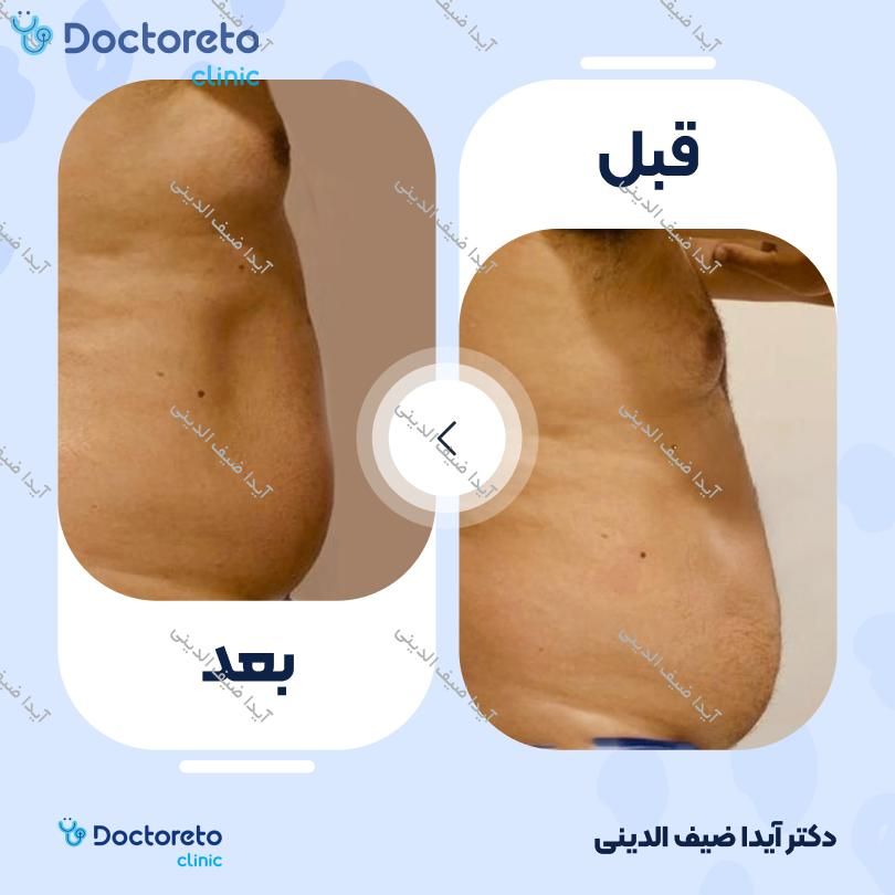 لاغری موضعی (شکم) با دستگاه کویتیشن (بانوان)(هرجلسه)