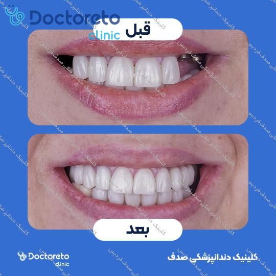 ایمپلنت core1 کره ای با روکش (هر واحد)