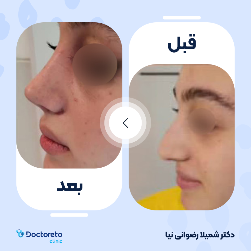 عمل زیبایی بینی گوشتی (رینوپلاستی) دکتر شمیلا رضوانی نیا در شیراز 11