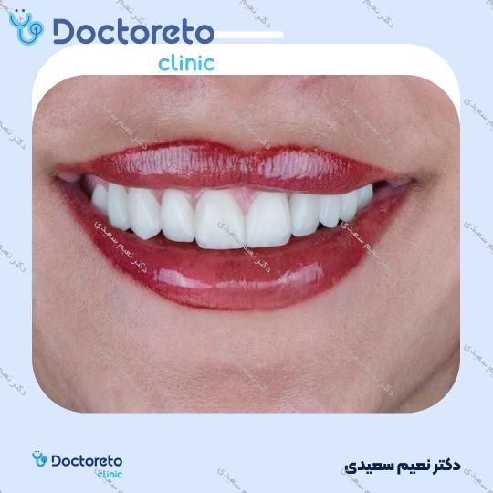 لمینت آی پی اس ایمکس (هر واحد)