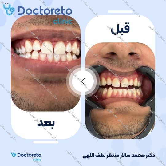 آفیس بلیچینگ (سفید کردن دندان) دو فک با مواد ایرانی