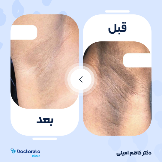 جوانسازی و رفع تیرگی پوست با کربوکسی تراپی (هر جلسه)