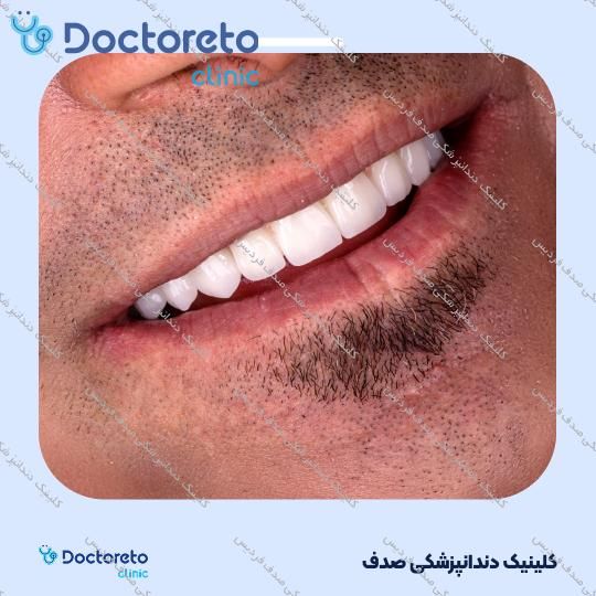ایمپلنت core1 کره ای با روکش (هر واحد)