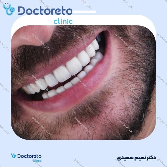 لمینت آی پی اس ایمکس (هر واحد)