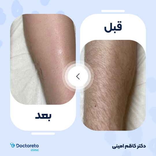 لیزر موهای زائد آقایان (پا ها) با دستگاه جونولوکس کره ای