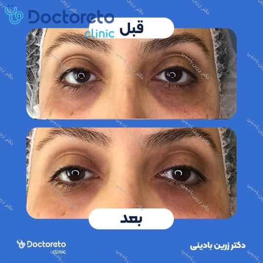 تزریق ژل زیر چشم با برند فیوریج (1cc)