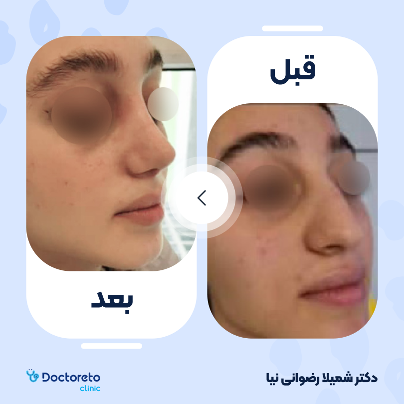 عمل زیبایی بینی گوشتی (رینوپلاستی) دکتر شمیلا رضوانی نیا در شیراز 10