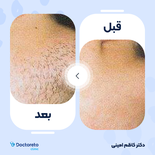 لیزر موهای زائد آقایان ( نیم تنه جلو) با دستگاه جونولوکس کره ای