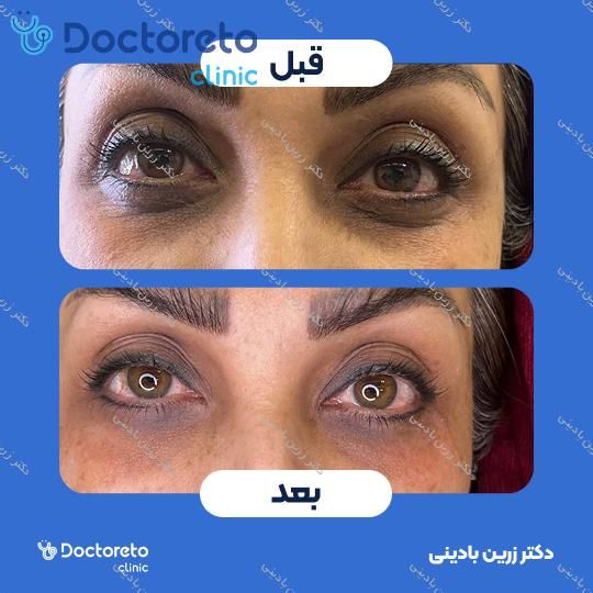 تزریق ژل زیر چشم با برند فیوریج (1cc)