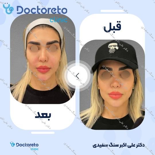 تزریق ژل لب با برند لیکوئید ایمپلنت (1cc)