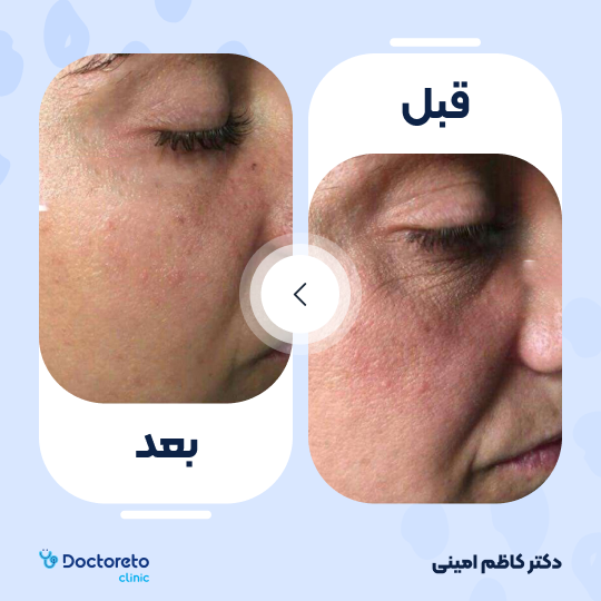 جوانسازی صورت با اگزوزوم تراپی و پلاسماتراپی (هر جلسه)