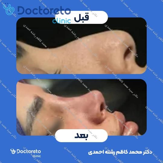 عمل زیبایی بینی (رینوپلاستی)