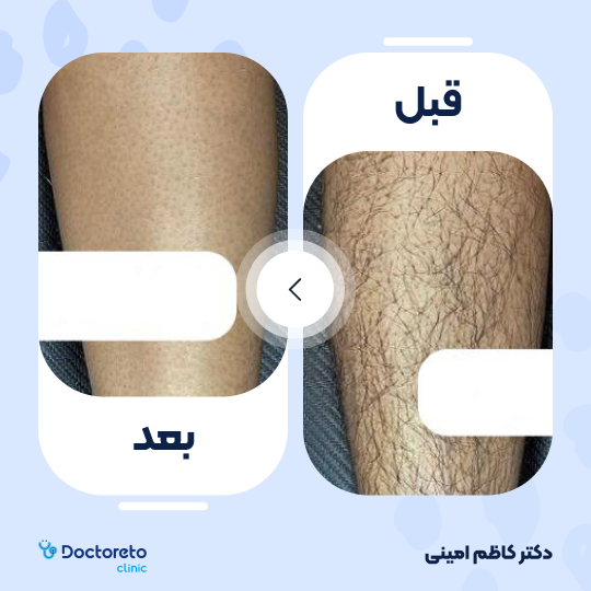 لیزر موهای زائد آقایان (پا ها) با دستگاه جونولوکس کره ای