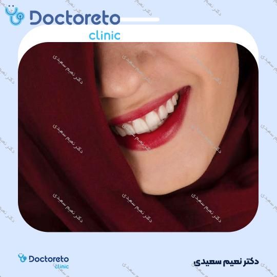 لمینت آی پی اس ایمکس (هر واحد)