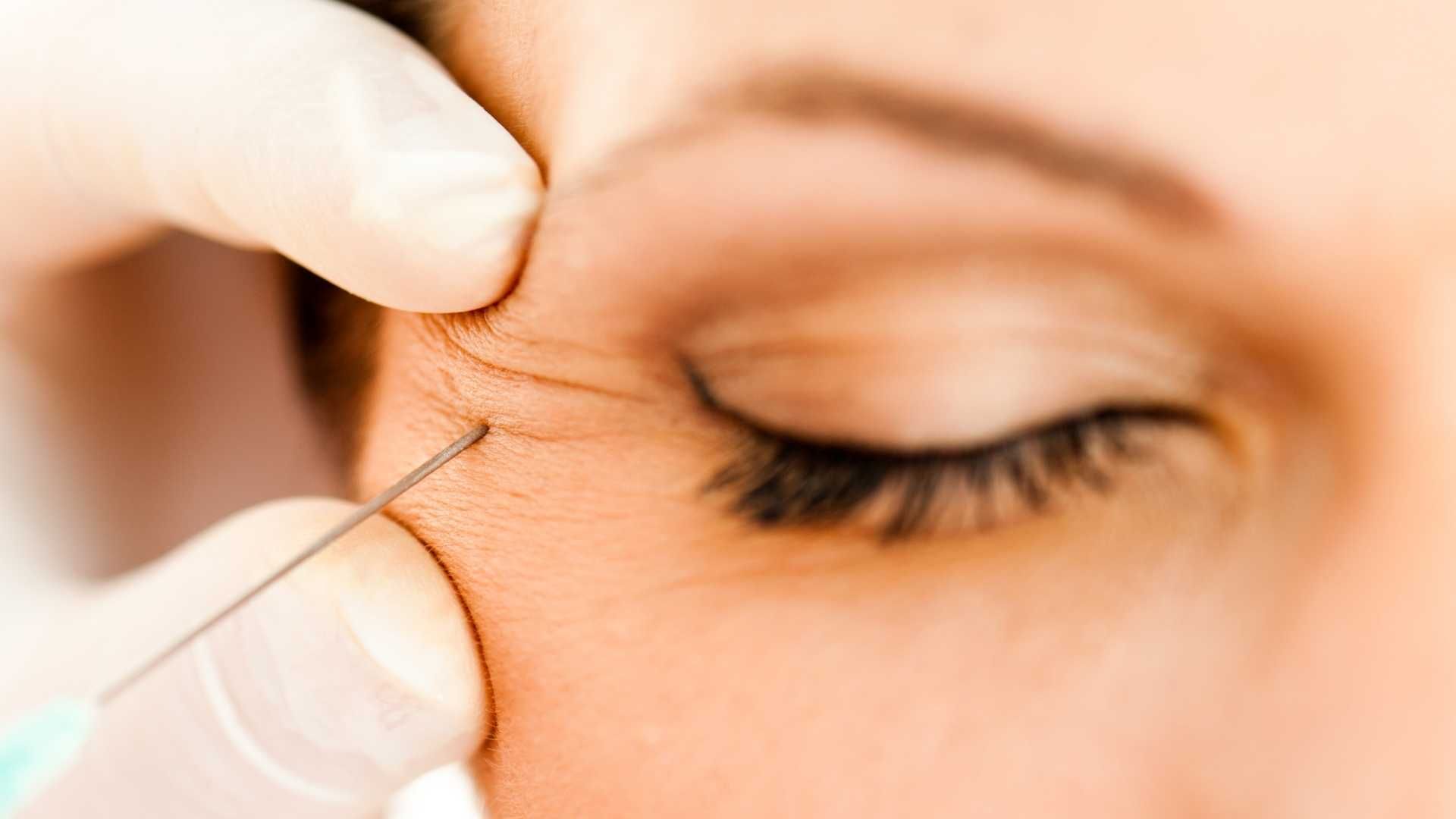 بوتاکس صورت (پیشانی، پنجه کلاغی، خط اخم، ) با برند دیستون