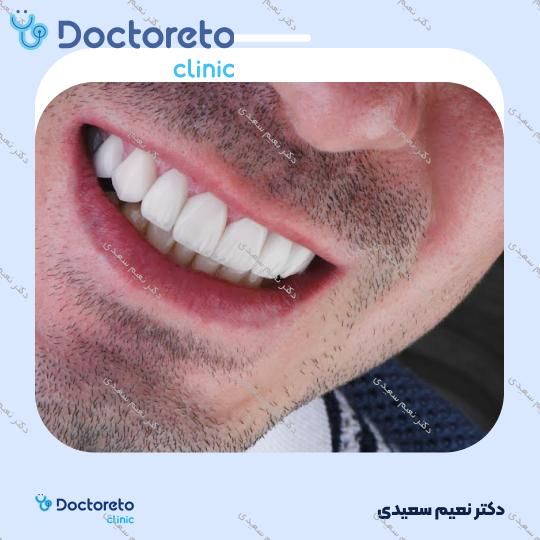 لمینت آی پی اس ایمکس (هر واحد)