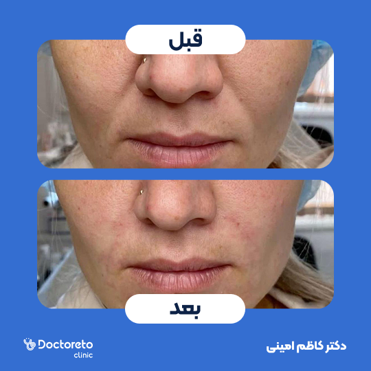 جوانسازی صورت با اگزوزوم تراپی و پلاسماتراپی (هر جلسه)