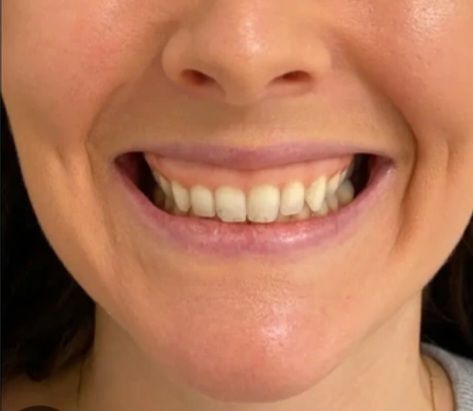 تزریق بوتاکس لبخند لثه ای با برند مصپورت