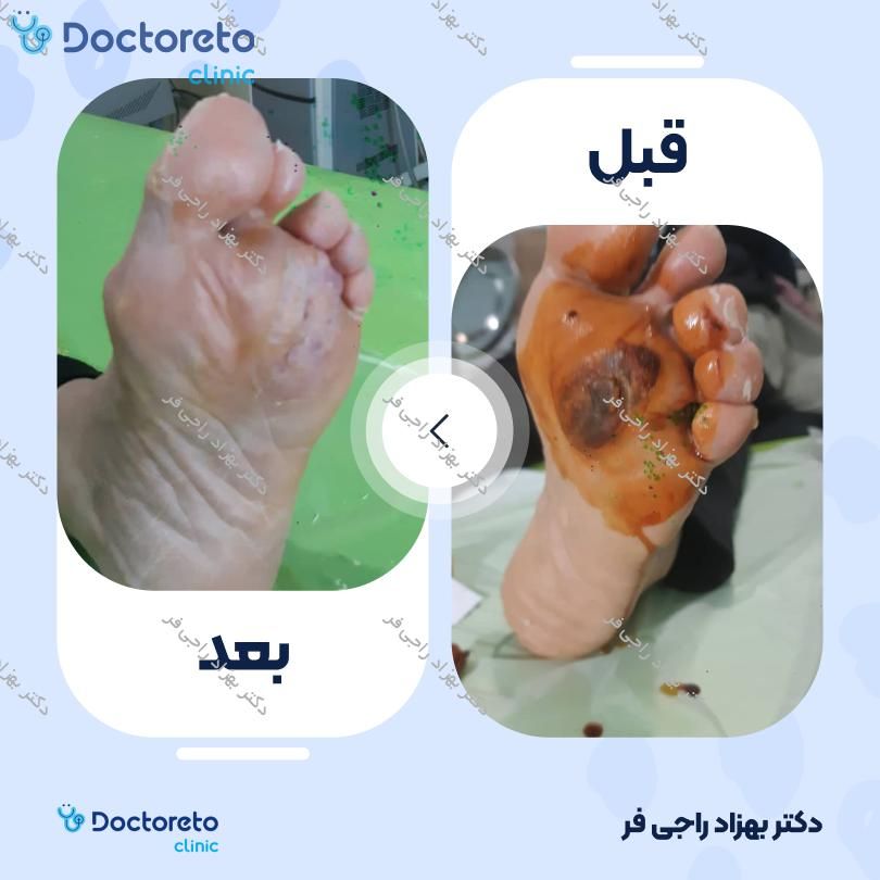درمان زخم دیابتی با لیزر Low level و high level اینگلیسی ( هرجلسه )
