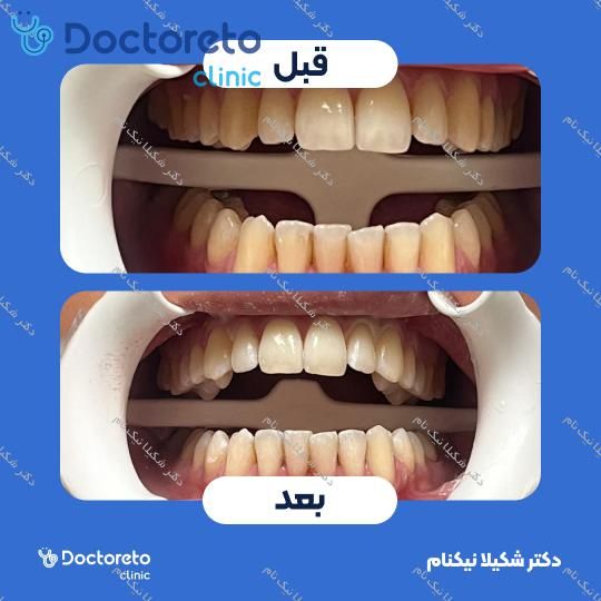هوم بلیچینگ دو فک با ماده آلمانی دکتر شکیلا نیک نام در تهران 19
