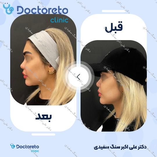 تزریق ژل چانه با برند الانسه (1cc)