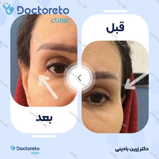 تزریق ژل شقیقه با برند فیوریج (1cc)