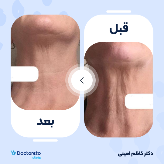 جوانسازی صورت با اگزوزوم تراپی و پلاسماتراپی (هر جلسه)
