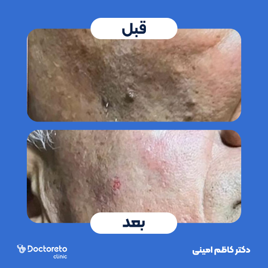 برداشتن توده لیپوم (جراحی برداشتن غده چربی) با جراحی
