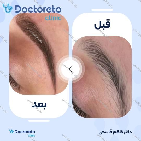 مزوتراپی ابرو با برند هیرکر فرانسه (هر جلسه)